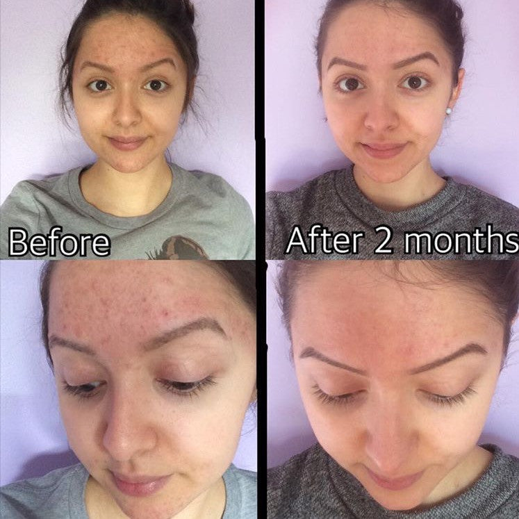 3-stappen acne systeem