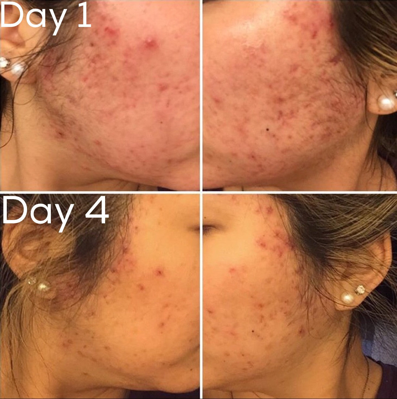 3-stappen acne systeem