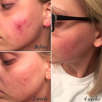 3-stappen acne systeem