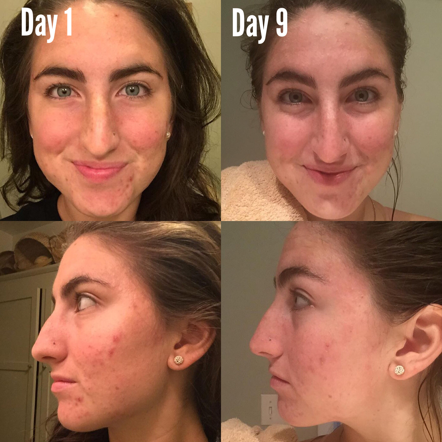 3-stappen acne systeem