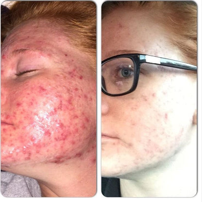 3-stappen acne systeem