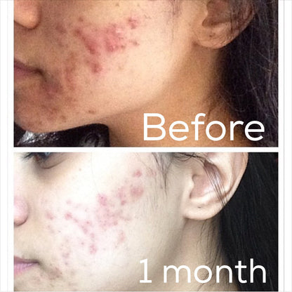 3-stappen acne systeem
